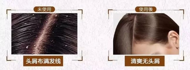 告別脫發(fā)、頭皮屑與頭發(fā)稀少的煩惱，重塑烏黑濃密的秀發(fā)